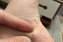 脚上起小水泡还很痒是怎么回事(脚上起小水泡很痒是怎么回事中医)