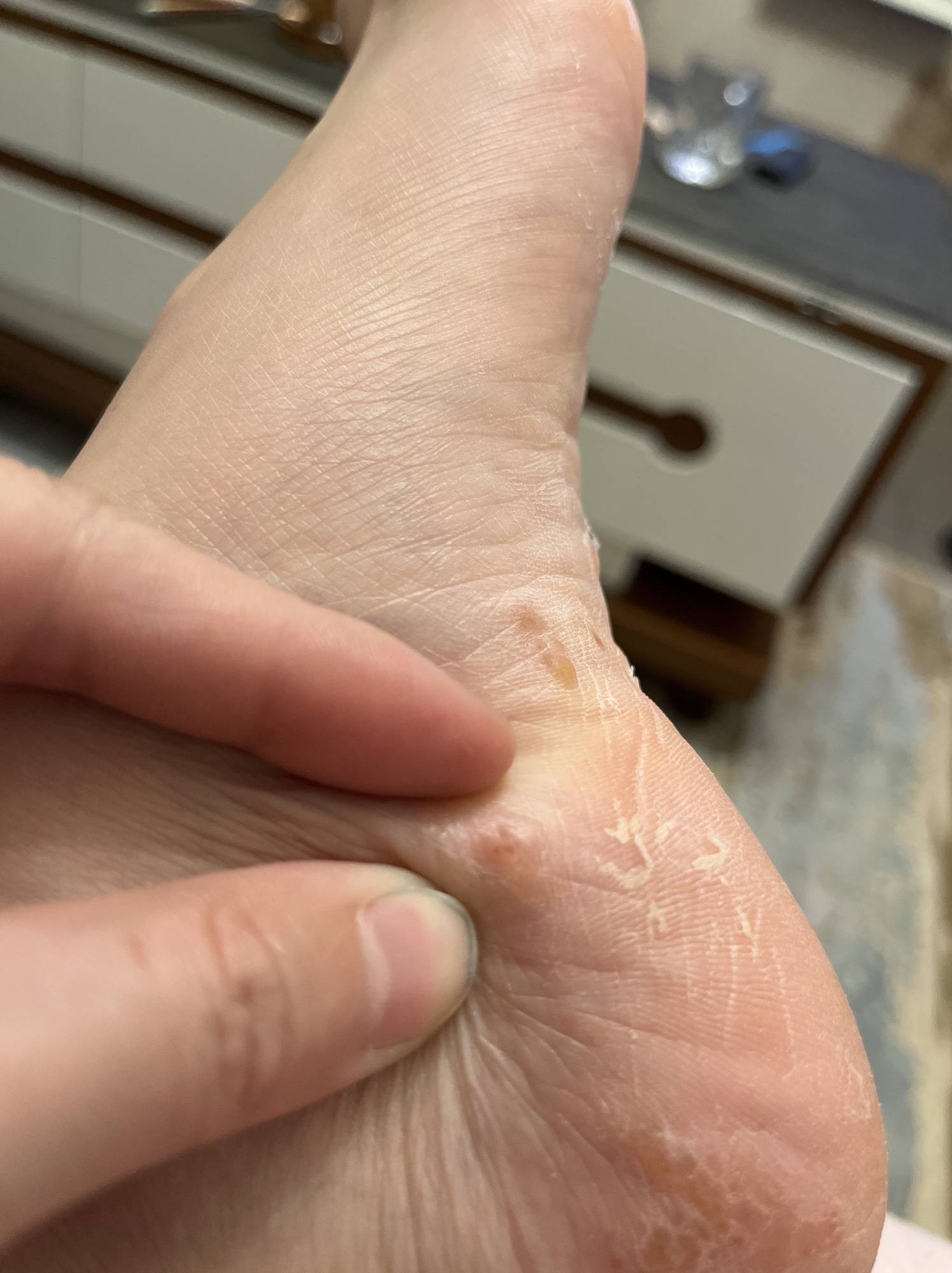脚上起小水泡还很痒是怎么回事(脚上起小水泡很痒是怎么回事中医)  第1张
